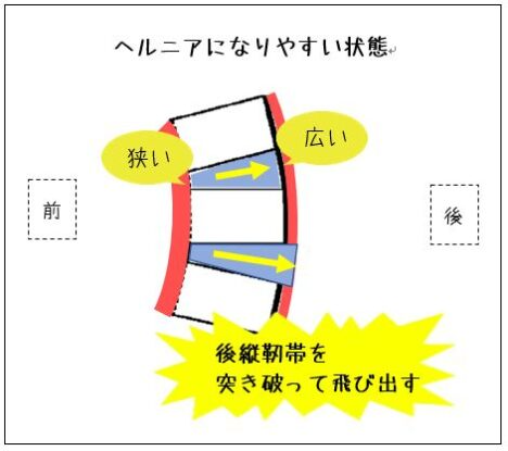 ヘルニアになりやすい状態