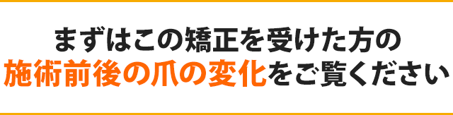 まずはこの矯正を受けた方の施術前後の爪の変化をご覧ください